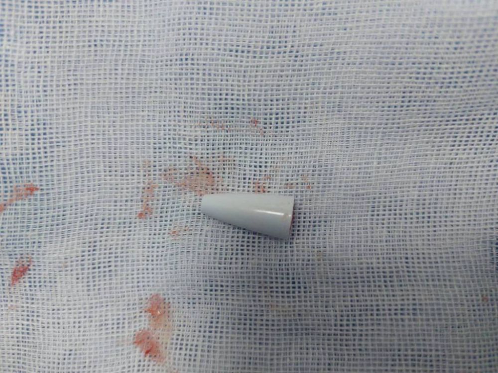 استخراج جسم غريب من الشعب الهوائية لطفل باستخدام المنظار الشعبي بمستشفى الأطفال