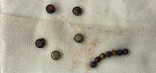 Mansoura University Children's Hospital successfully saved a child who had swallowed 20 objects using a combined endoscopic and surgical procedure